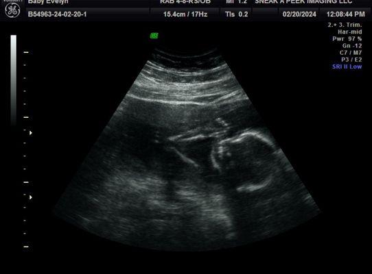 19 week Ultrasound