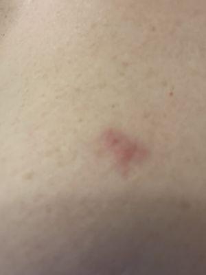 Bedbug bites