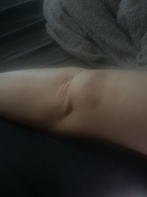 Bruised arm