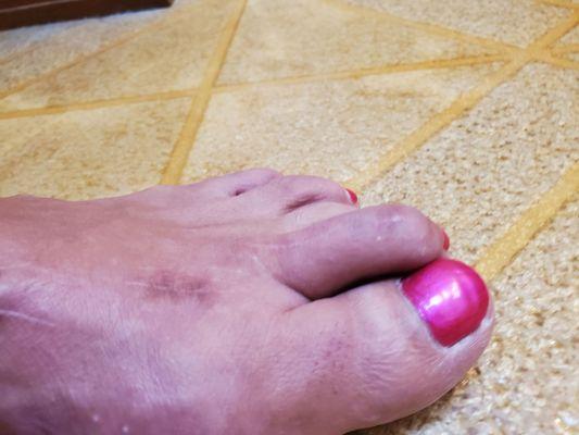 Terrible hammertoe correction!