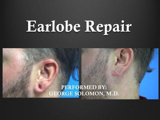 Earlobe repair from gages