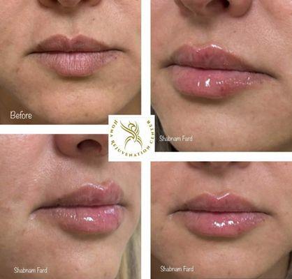 Lip Treatments