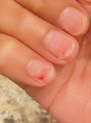 Part of Pink nail ripped