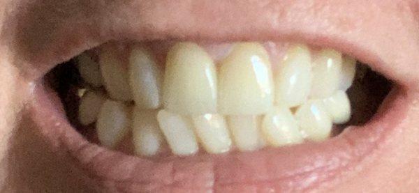 My two new front crowns!  Thank you Dr.Teeth and your amazing team of professionals... You all really made me happy to smile again!