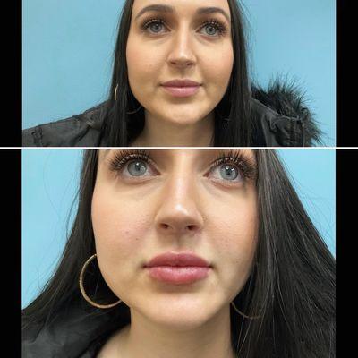 Before and after lip filler