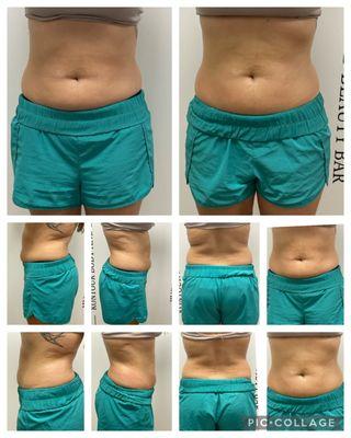 This client received 6 sessions of cavitation. Book your consultation today.