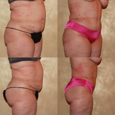 Abdominoplasty Tummy Tuck