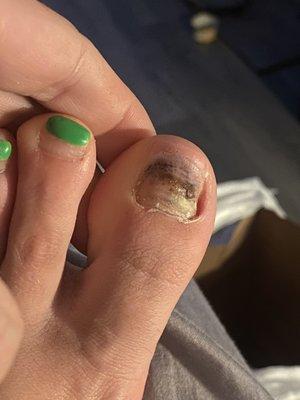 I assume fungus???? Underneath my toenail on the soft bed.