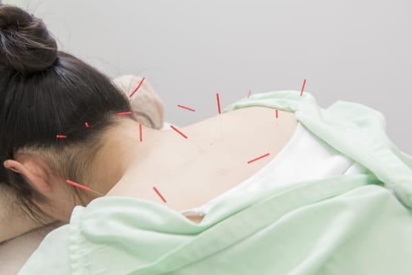 Japanese Style Acupuncture