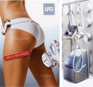 Endermologie Lipo Massage, really works!