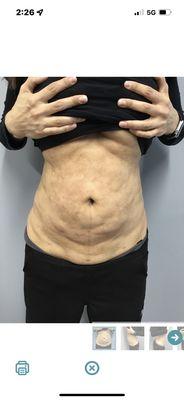 Lumpy after 6 months Lipo with Dr Fig