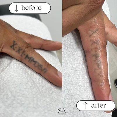 Number # 1 Tattoo Removal