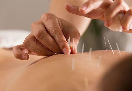 Acupuncture Therapy