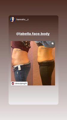 Body contouring