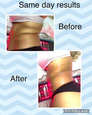 This client received 1 session of cavitation, wood therapy and laser lipo. Book your consultation today.