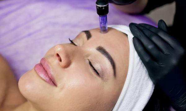 Microneedling treatment