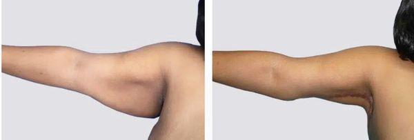 Arm Lift Before and After