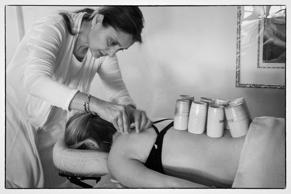 Patient in prone position recieving acupuncture, and cupping on the low back area