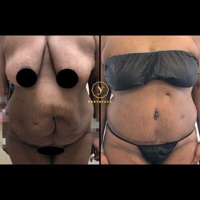 Tummy tuck with hernia repair