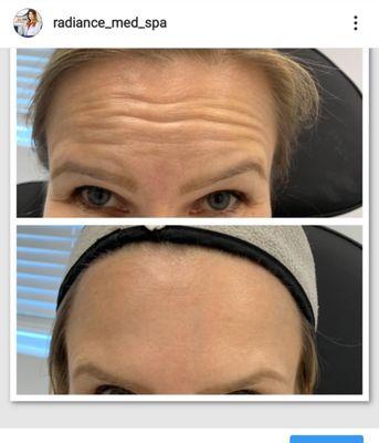 Dysport in forehead to create glow and much smoother look.