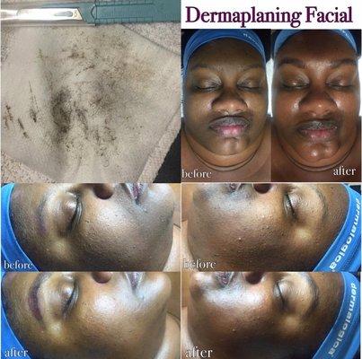 Dermaplaning facial