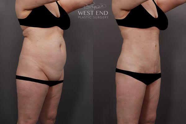 Dr. Ruff performed a Mons Pubis Lift, Liposuction & Renuvion Skin Tightening.