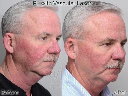 Intense Pulsed Light (IPL) treats rosacea, or the pink coloration that some people have to their face and cheeks.