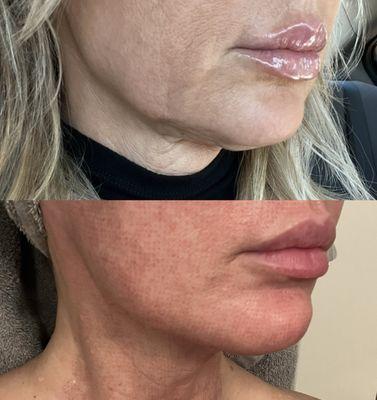 Before and after 5 days post treatment with Matrix RF Microneedling and Ultraclear Erbium Laser.