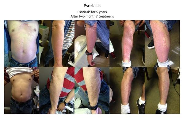 Psoraisis for 5 years. After 2 months' treatment.