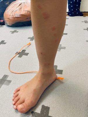 Bed bug bite