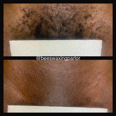 Before and after of a Brazilian wax.