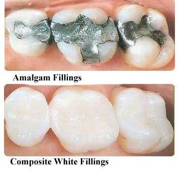 Replace your worn out amalgam fillings with porcelain in one day!