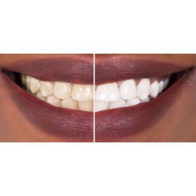 Laser Teeth Whitening