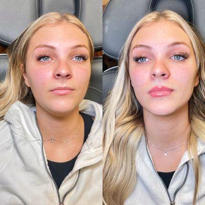 Lip Filler -- Before + After!!!