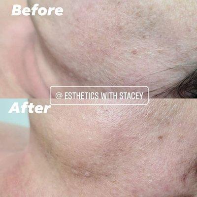 A before + after of Dermaplaning!