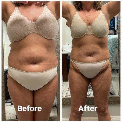 Before & After 1 session of CoolSculpting