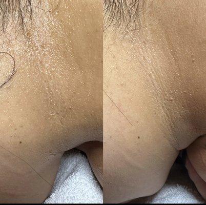 Neck Skin Repair/ Skin Lightening