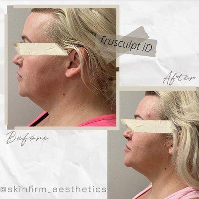 Trusculpt non-invasive fat loss treatment