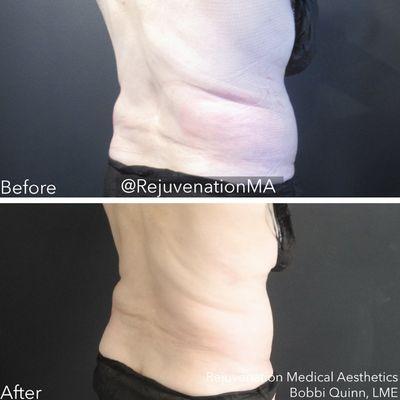 CoolSculpting Results