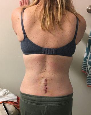 After the third back surgery