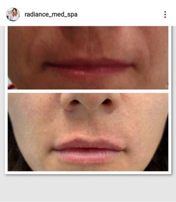 Natural yet beautiful created by injecting Restylane Refyne!