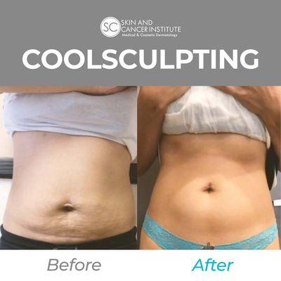 Book Coolsculpting Now! - Mention Yelp!