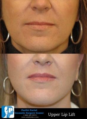 Lip Lift by Dr. Richard Parfitt