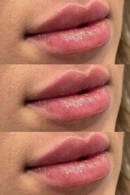 Restylane Kysse Lip Filler