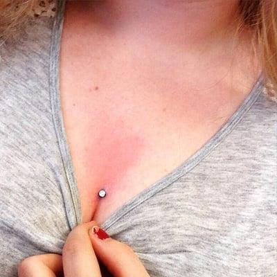 My dermal piercing right after it was done.