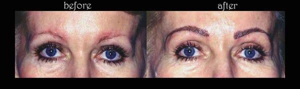 Microblading to improve scared brow area