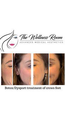 Crows feet treatment with Dysport