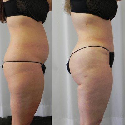 Tummy Tuck with hip and thigh Liposuction