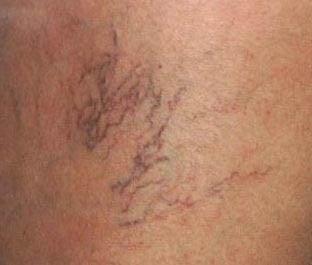 Spider Vein Removal - Memphis Vein Clinic