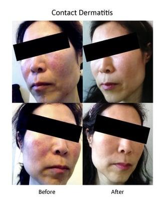 Contact dermatitis treated by Chinese herbs